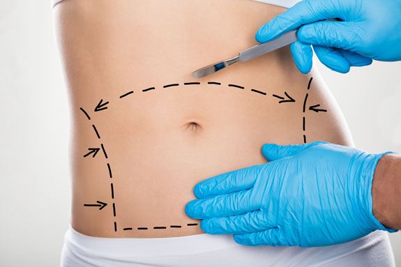 Abdominoplastik Nordrhein-Westfalen