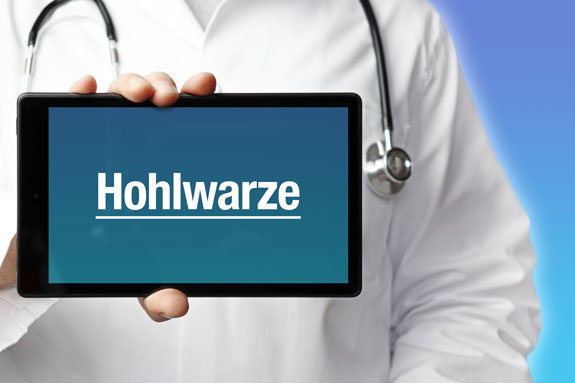 Schlupfwarzen Nordrhein-Westfalen